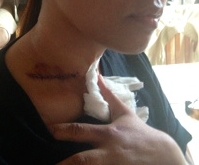 Stiches